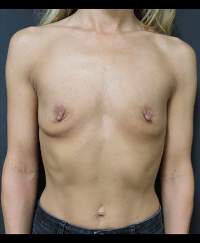 Breast Augmentation Before & After Gallery - Patient 122908853 - Image 1