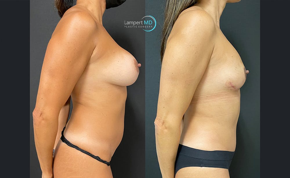 Breast Explant Before & After Gallery - Patient 122908847 - Image 3