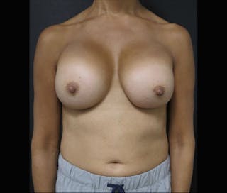 Breast Revision Before & After Gallery - Patient 122908852 - Image 2