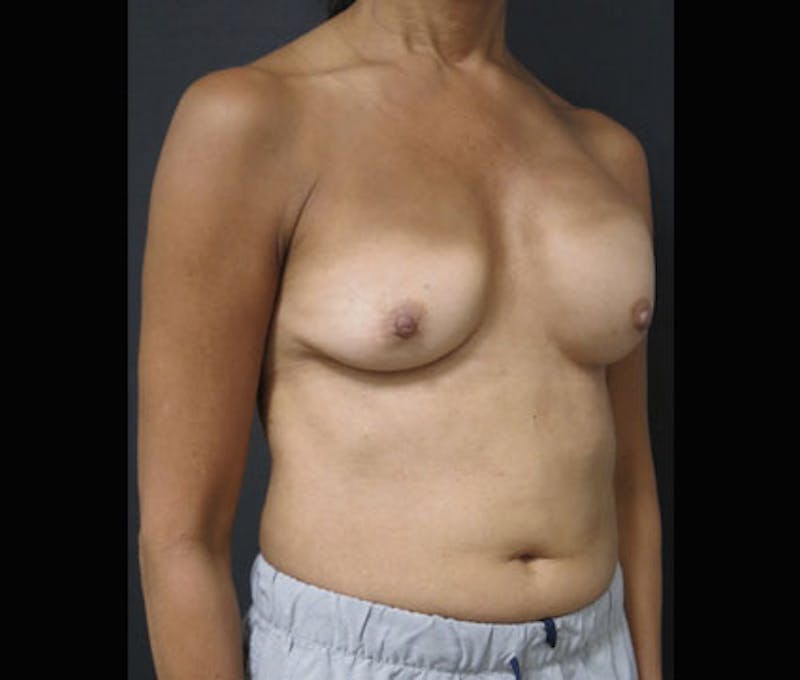 Breast Revision Before & After Gallery - Patient 122908852 - Image 3
