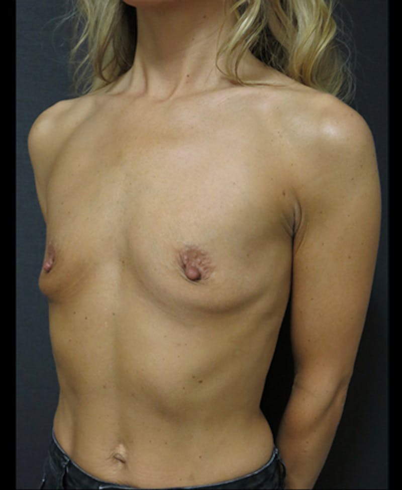 Breast Augmentation Before & After Gallery - Patient 122908853 - Image 7