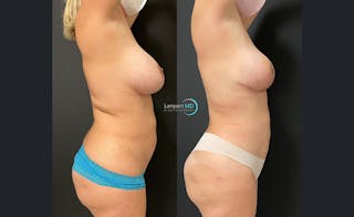 Breast Explant Before & After Gallery - Patient 122908851 - Image 3