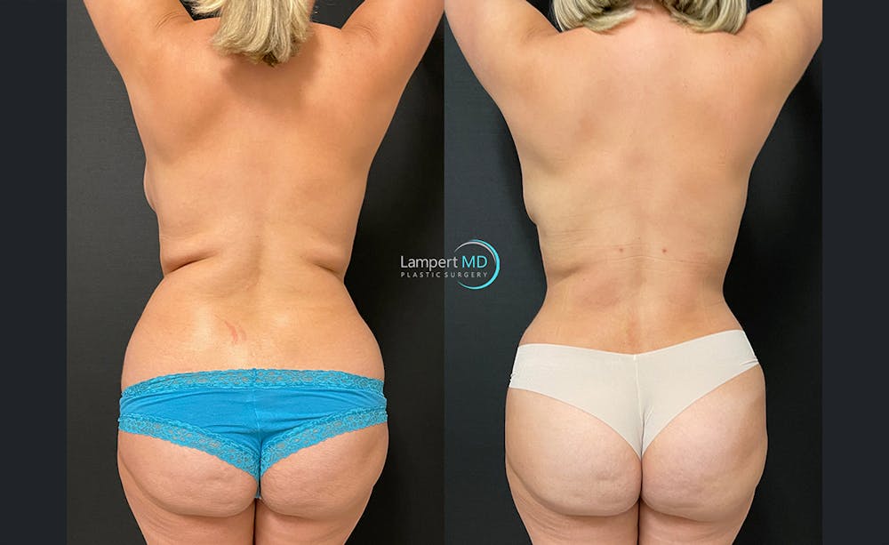 Breast Explant Before & After Gallery - Patient 122908851 - Image 4