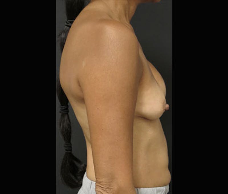 Breast Revision Before & After Gallery - Patient 122908852 - Image 5