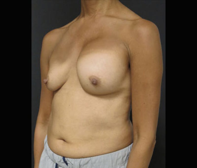 Breast Revision Before & After Gallery - Patient 122908852 - Image 7