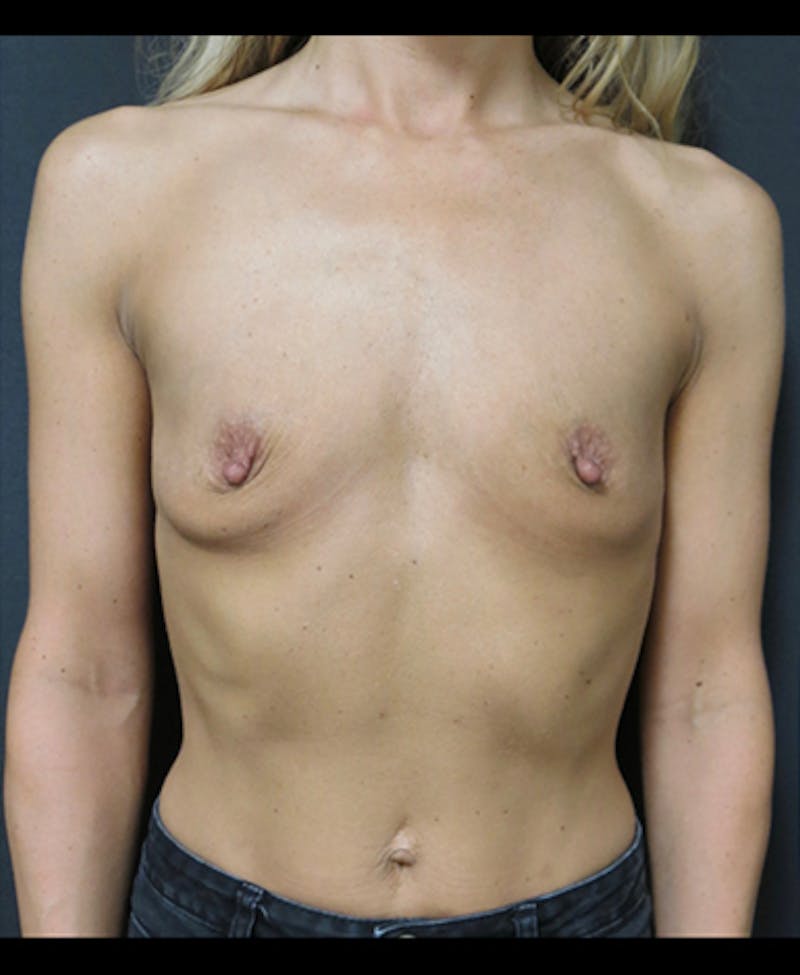 Breast Augmentation Before & After Gallery - Patient 122908853 - Image 11
