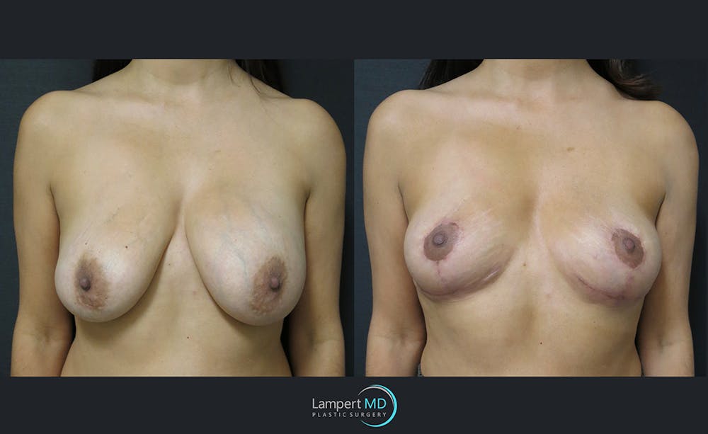 Breast Explant Before & After Gallery - Patient 122908854 - Image 1