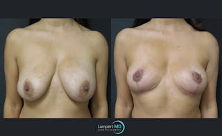 Breast Explant Before & After Gallery - Patient 122908854 - Image 1