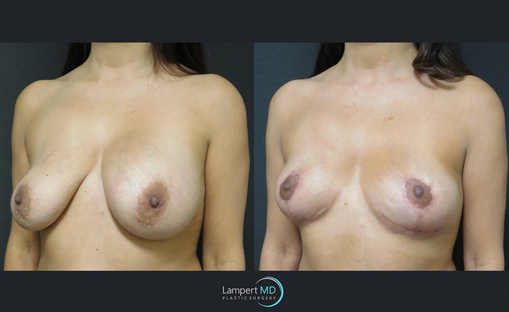 Breast Explant Before & After Gallery - Patient 122908854 - Image 2