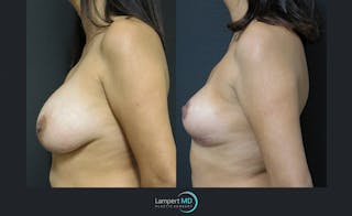 Breast Explant Before & After Gallery - Patient 122908854 - Image 3