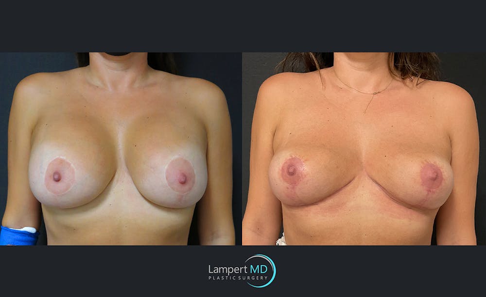 Breast Explant Before & After Gallery - Patient 122908857 - Image 1