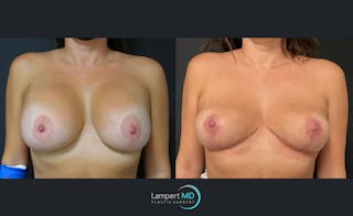 Breast Explant Before & After Gallery - Patient 122908857 - Image 1