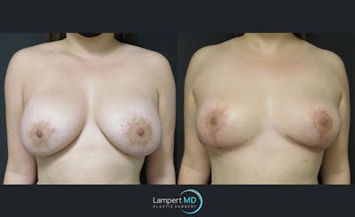 Breast Explant Before & After Gallery - Patient 122908859 - Image 1