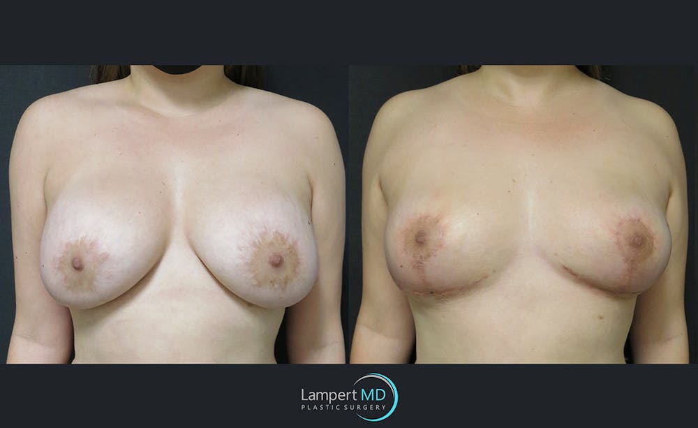 Breast Explant Before & After Gallery - Patient 122908859 - Image 1