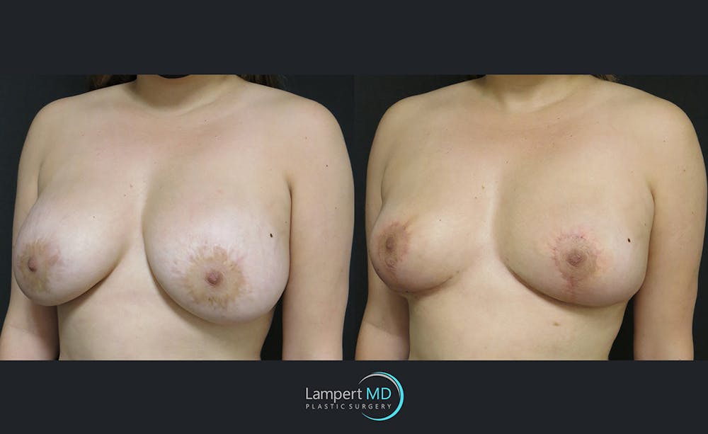Breast Explant Before & After Gallery - Patient 122908859 - Image 2