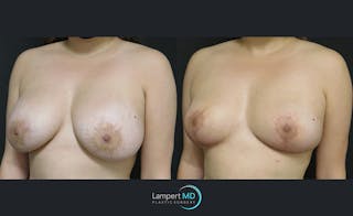 Breast Explant Before & After Gallery - Patient 122908859 - Image 2
