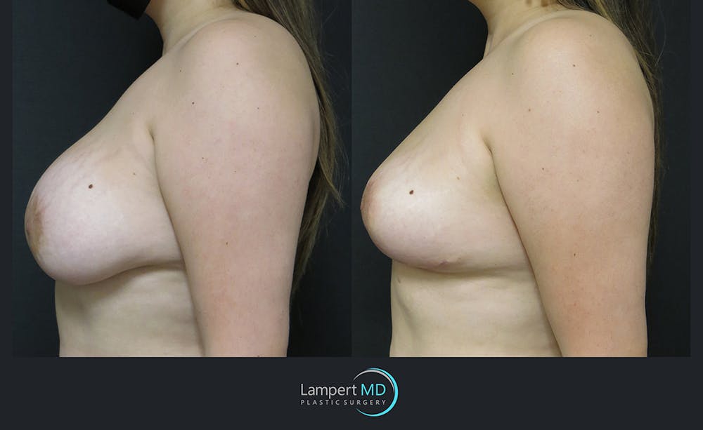 Breast Explant Before & After Gallery - Patient 122908859 - Image 3