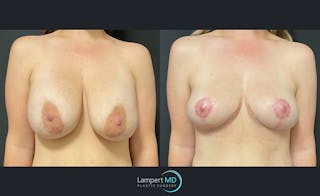 Breast Explant Before & After Gallery - Patient 122908862 - Image 1