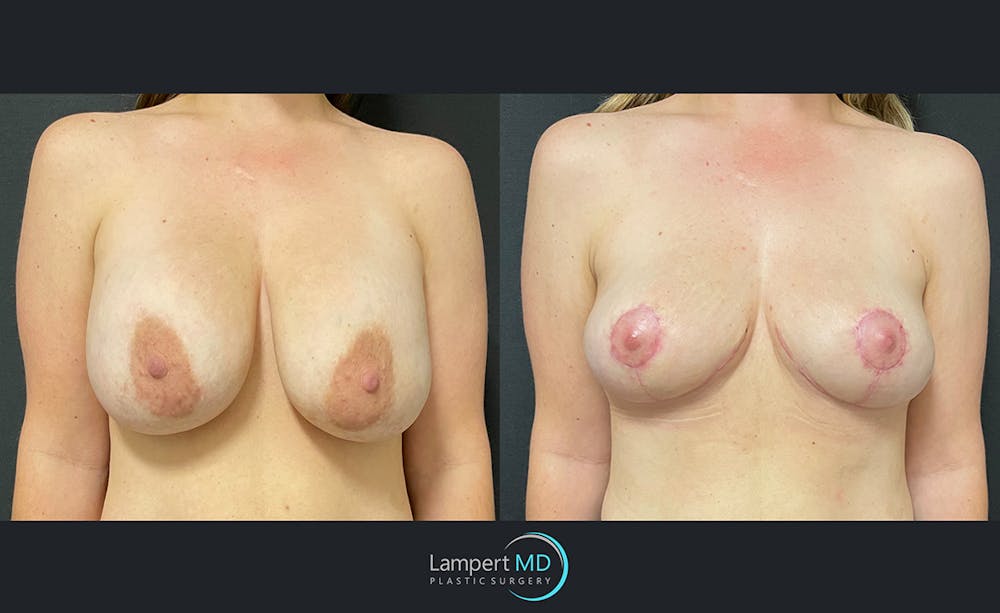 Breast Explant Before & After Gallery - Patient 122908862 - Image 1