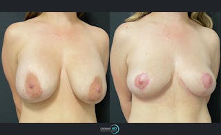 Breast Explant Before & After Gallery - Patient 122908862 - Image 2