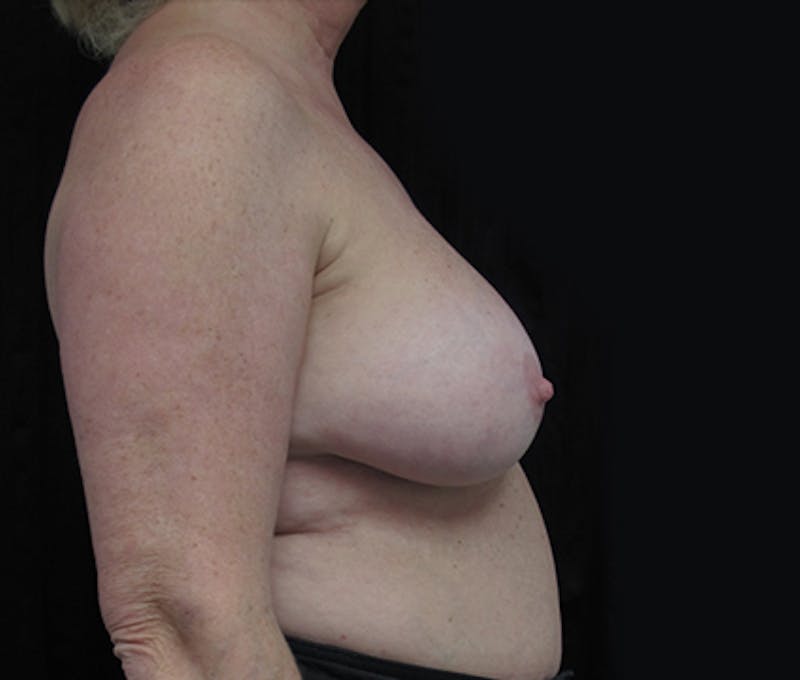 Breast Revision Before & After Gallery - Patient 122908860 - Image 9
