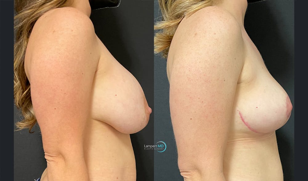 Breast Explant Before & After Gallery - Patient 122908862 - Image 3