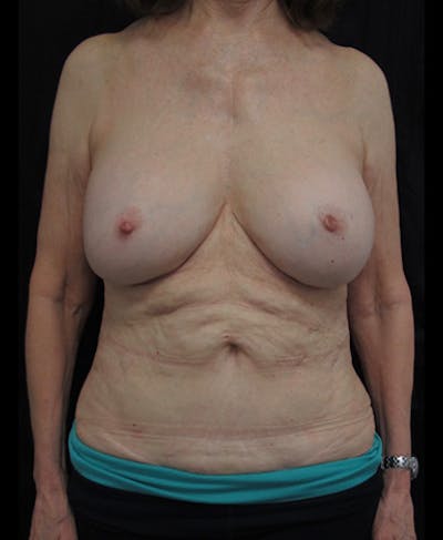 Breast Revision Before & After Gallery - Patient 122908863 - Image 1