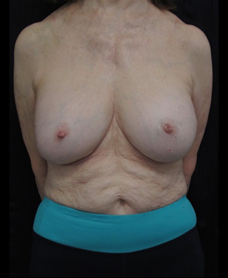 Breast Revision Before & After Gallery - Patient 122908863 - Image 3