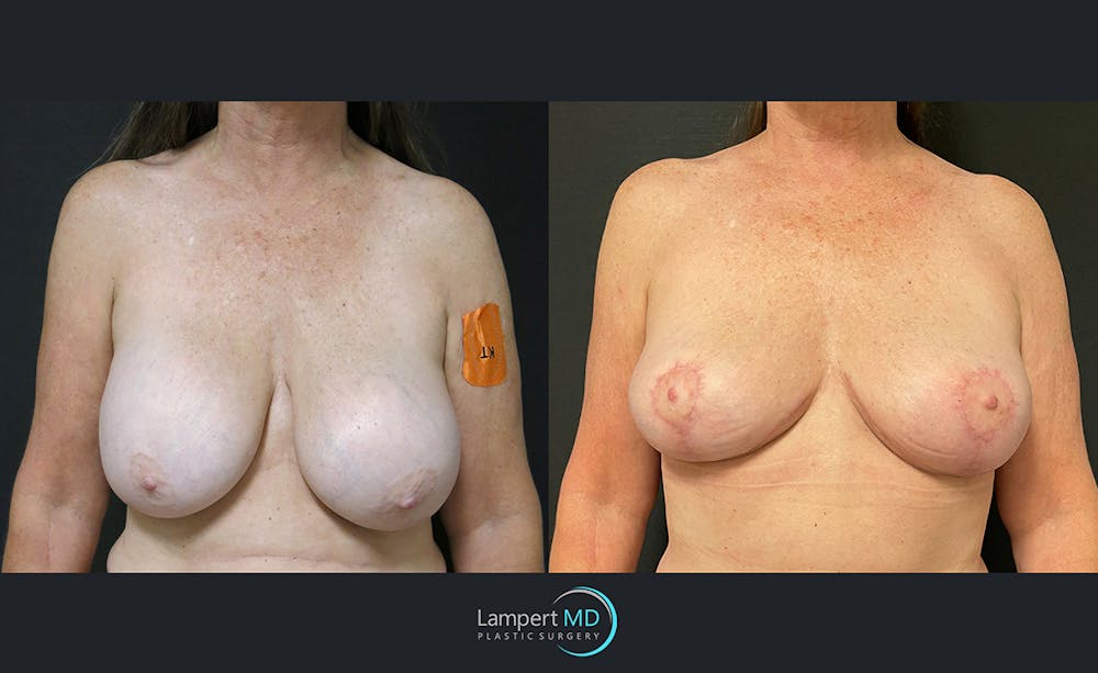 Breast Explant Before & After Gallery - Patient 122908864 - Image 1