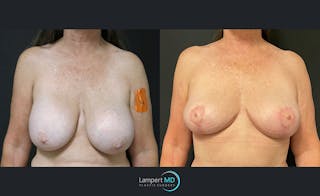 Breast Explant Before & After Gallery - Patient 122908864 - Image 1