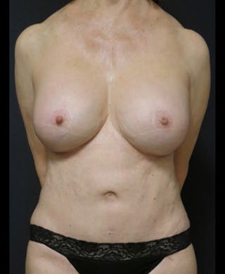 Breast Revision Before & After Gallery - Patient 122908863 - Image 4
