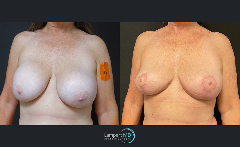 Breast Explant Before & After Gallery - Patient 122908864 - Image 2