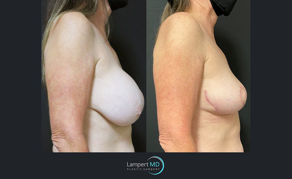 Breast Explant Before & After Gallery - Patient 122908864 - Image 3