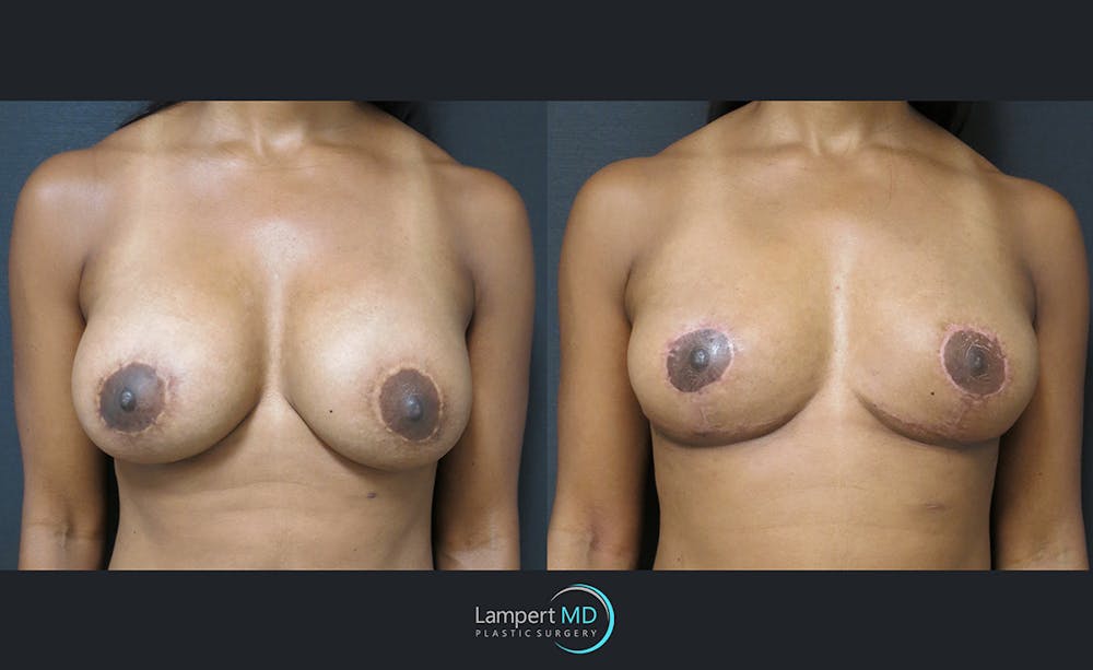 Breast Explant Before & After Gallery - Patient 122908867 - Image 1