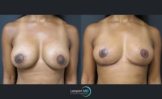 Breast Explant Before & After Gallery - Patient 122908867 - Image 1