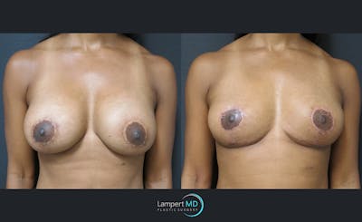Breast Explant Before & After Gallery - Patient 122908867 - Image 1