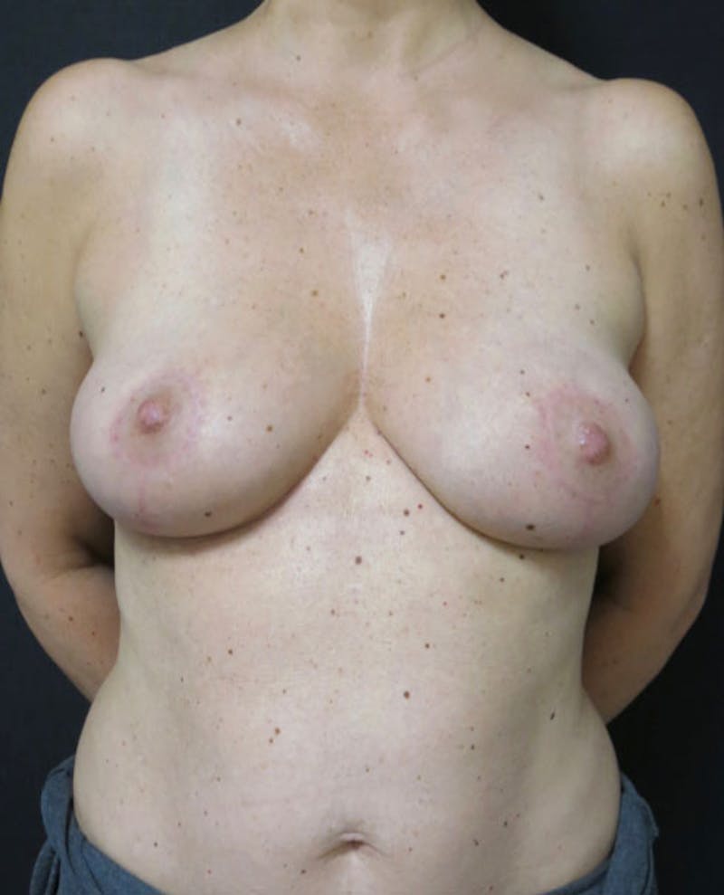 Breast Revision Before & After Gallery - Patient 122908894 - Image 4