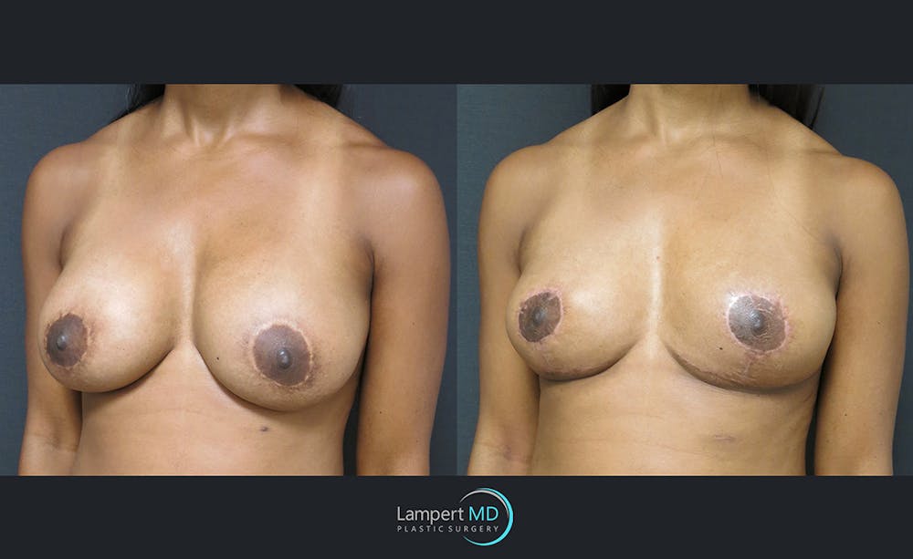 Breast Explant Before & After Gallery - Patient 122908867 - Image 2