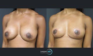 Breast Explant Before & After Gallery - Patient 122908867 - Image 2