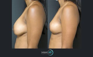 Breast Explant Before & After Gallery - Patient 122908867 - Image 3