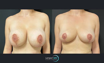 Breast Explant Before & After Gallery - Patient 122908868 - Image 1
