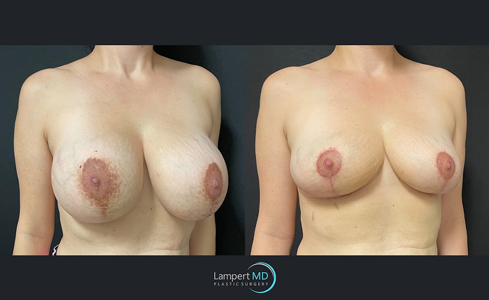 Breast Explant Before & After Gallery - Patient 122908868 - Image 2