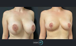 Breast Explant Before & After Gallery - Patient 122908868 - Image 2