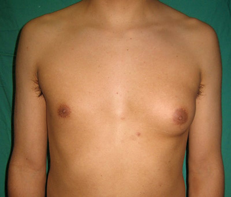 Gynecomastia Before & After Gallery - Patient 122908881 - Image 1