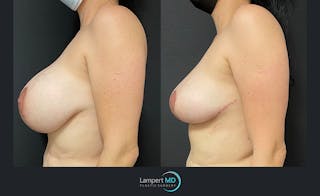 Breast Explant Before & After Gallery - Patient 122908868 - Image 3