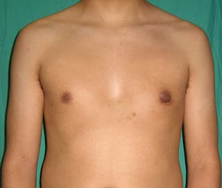 Gynecomastia Before & After Gallery - Patient 122908881 - Image 2