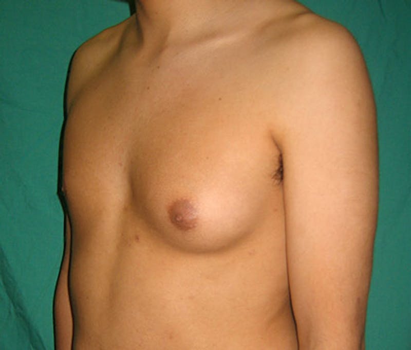 Gynecomastia Before & After Gallery - Patient 122908881 - Image 3