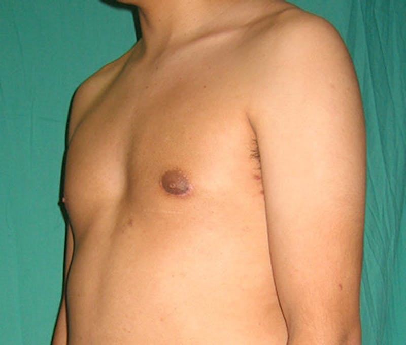 Gynecomastia Before & After Gallery - Patient 122908881 - Image 4