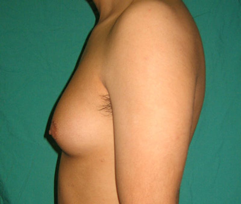 Gynecomastia Before & After Gallery - Patient 122908881 - Image 5