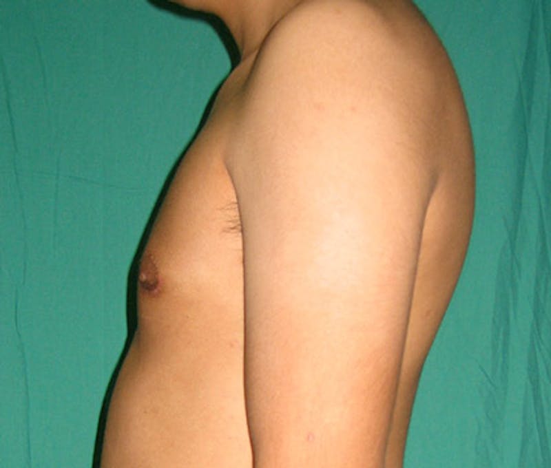 Gynecomastia Before & After Gallery - Patient 122908881 - Image 6